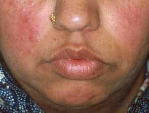 rosacea3